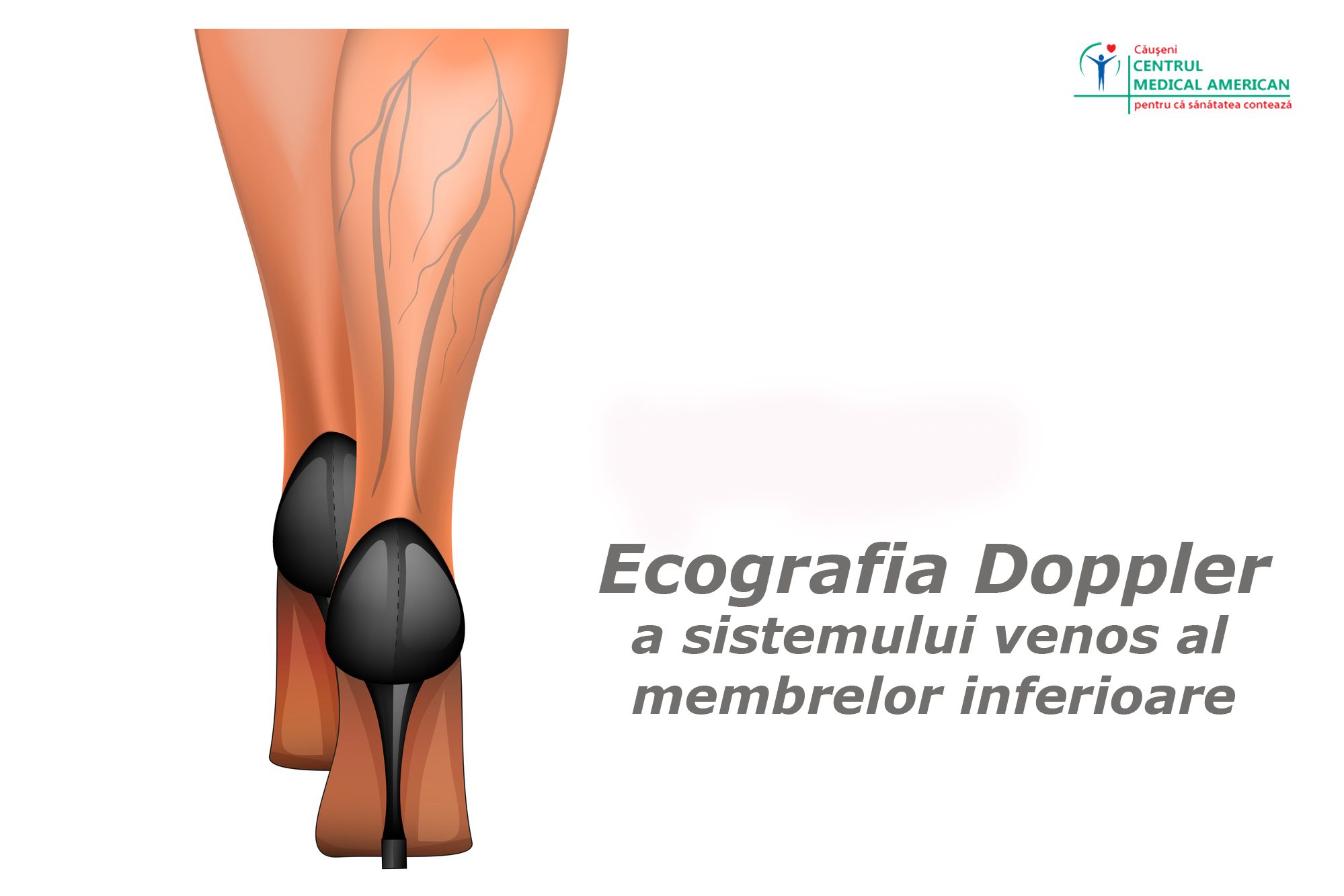 venele varicoase urologice